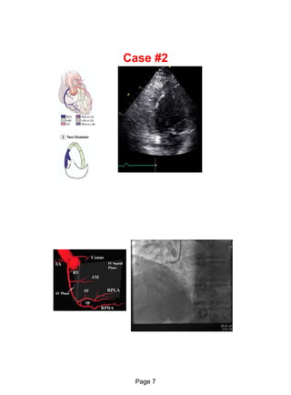 Echo in ischaemic heart disease and Myocardial infarction | PDF