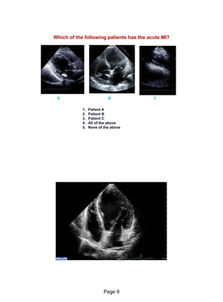 Echo in ischaemic heart disease and Myocardial infarction | PDF