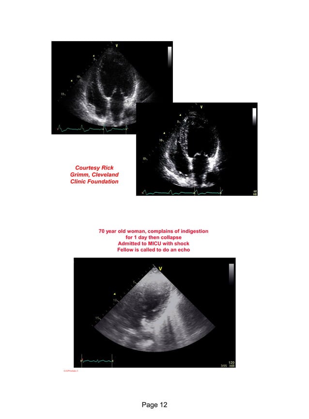 Echo in ischaemic heart disease and Myocardial infarction