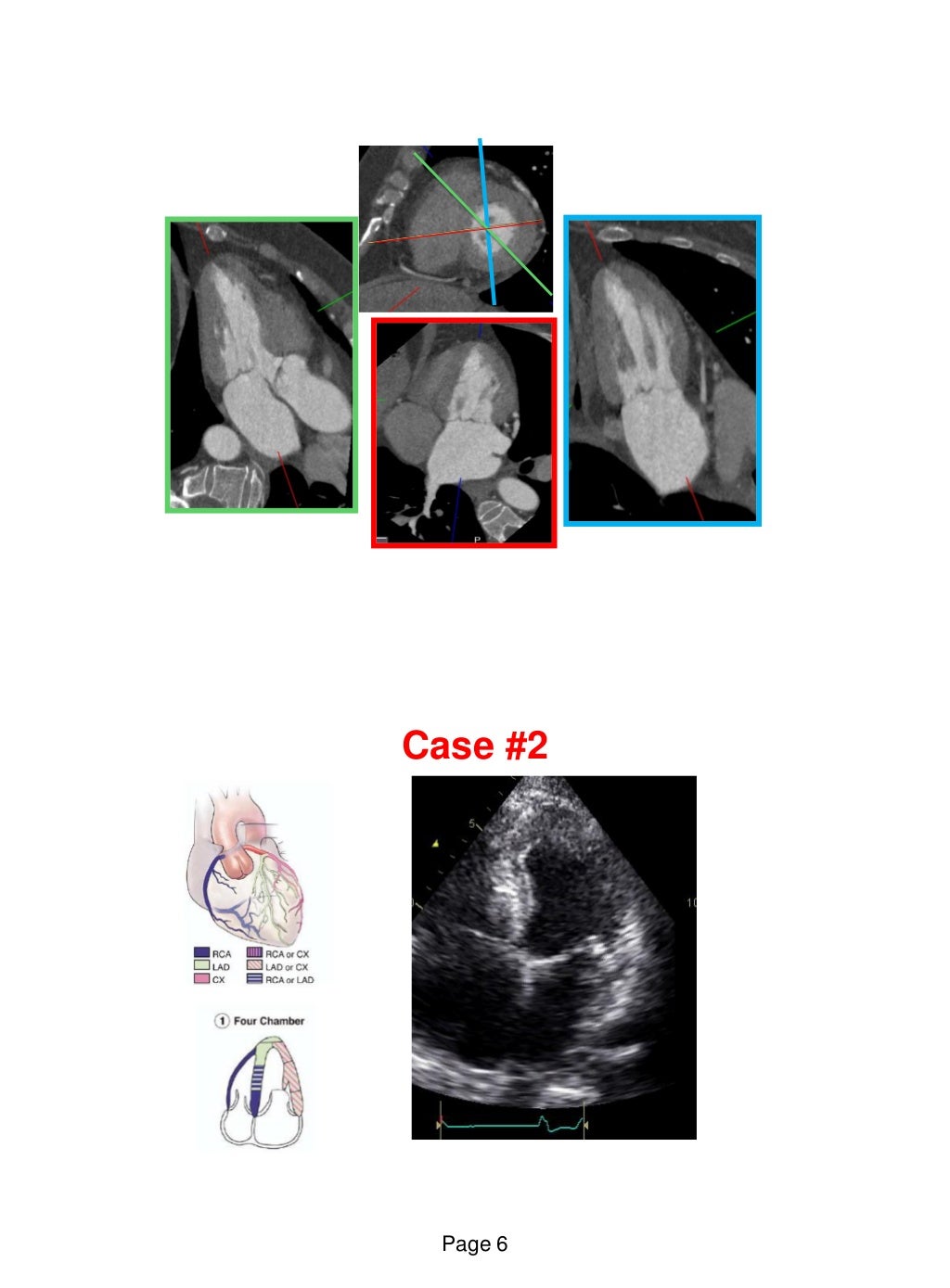 Echo in ischaemic heart disease and Myocardial infarction