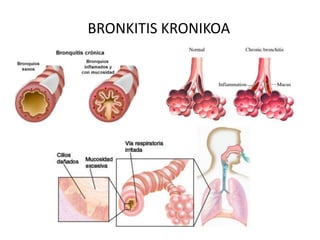BRONKITIS KRONIKOA
 