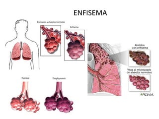 ENFISEMA
 