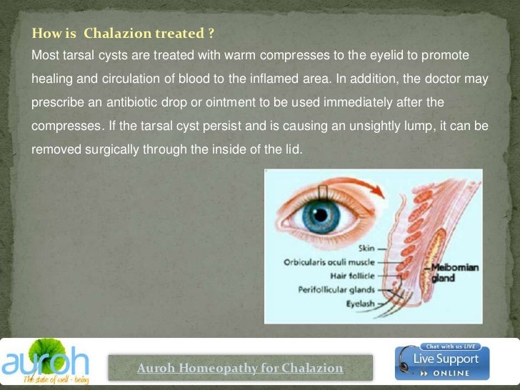 Auroh chalazion homeopathic treatment