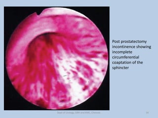 Post prostatectomy
incontinence showing
incomplete
circumferential
coaptation of the
sphincter
14
Dept of Urology, GRH and KMC, Chennai.
 