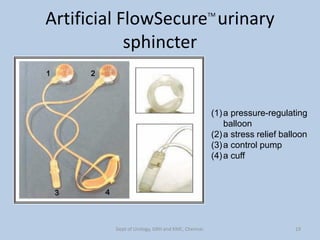 Artificial FlowSecureTM
urinary
sphincter
(1)a pressure-regulating
balloon
(2)a stress relief balloon
(3)a control pump
(4)a cuff
19
Dept of Urology, GRH and KMC, Chennai.
 
