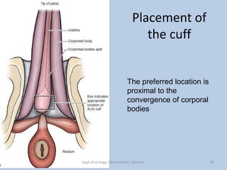 Placement of
the cuff
The preferred location is
proximal to the
convergence of corporal
bodies
36
Dept of Urology, GRH and KMC, Chennai.
 