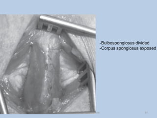 -Bulbospongiosus divided
-Corpus spongiosus exposed
37
Dept of Urology, GRH and KMC, Chennai.
 