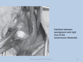 Interface between
spongiosum and right
crus of the
cavernosum dissected
38
Dept of Urology, GRH and KMC, Chennai.
 