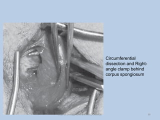 Circumferential
dissection and Right-
angle clamp behind
corpus spongiosum
39
Dept of Urology, GRH and KMC, Chennai.
 