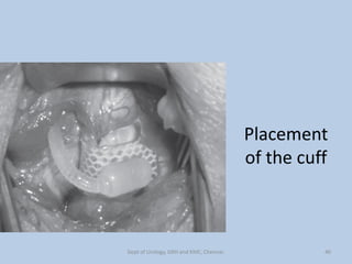 Placement
of the cuff
40
Dept of Urology, GRH and KMC, Chennai.
 
