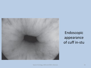 Endoscopic
appearance
of cuff in-stu
42
Dept of Urology, GRH and KMC, Chennai.
 