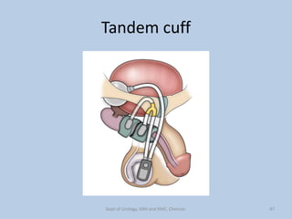 Tandem cuff
47
Dept of Urology, GRH and KMC, Chennai.
 