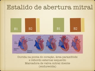 Estalido de abertura mitral
B2
Ouvida na ponta do coração, área paraxifoide
e rebordo esternal esquerdo
Marcadora de valva mitral doente
(endurecida)
B1 B2B1
 