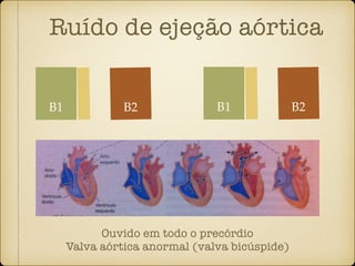 Ruído de ejeção aórtica
B1 B2
Ouvido em todo o precórdio
Valva aórtica anormal (valva bicúspide)
B1 B2
 