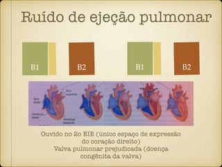 Ruído de ejeção pulmonar
B1 B2
Ouvido no 2o EIE (único espaço de expressão
do coração direito)
Valva pulmonar prejudicada (doença
congênita da valva)
B1 B2
 