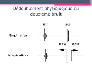 Dédoublement physiologique du
       deuxième bruit
 