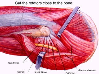Quadratus Gemeli Piriformis Sciatic Nerve Gluteus Maximus Cut the rotators close to the bone 