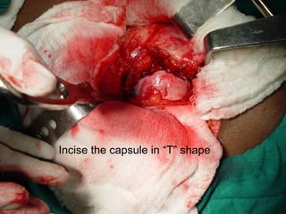 Incise the capsule in “T” shape 