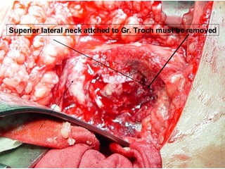 Superior lateral neck attched to Gr. Troch must be removed 