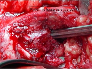 Piriformis fossa as entry point 