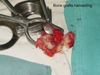 Bone grafts harvesting 