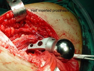 Half inserted prosthesis 