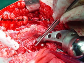 Packing of graft in the medial wall 