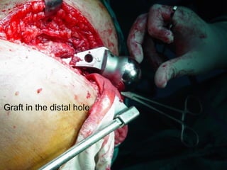 Graft in the distal hole 