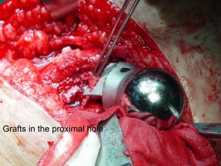 Grafts in the proximal hole 