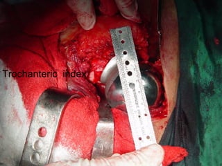 Trochanteric  index 