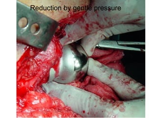 Reduction by gentle pressure 