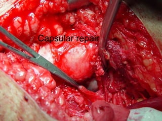 Capsular repair 