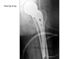 Post Op X-ray 