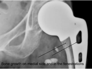 Bone growth on medial side and in the fenestrations 