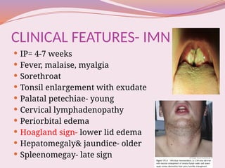 Acute Laryngitis - Detailed Presentation.pptx