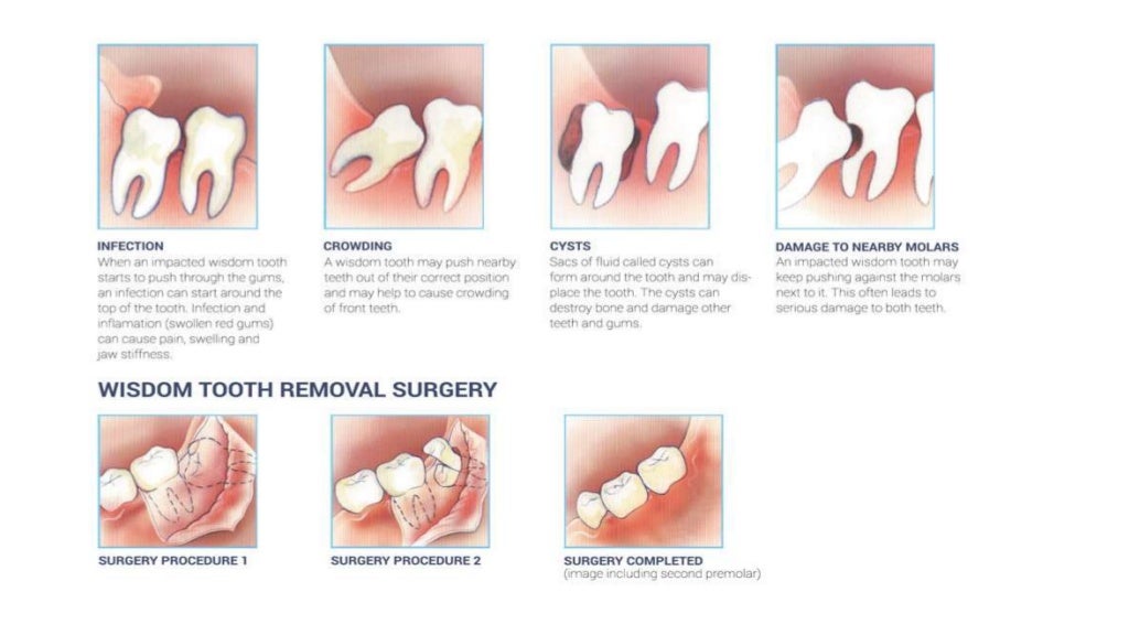 Stonehill Dental Warning Signs of Impacted Wisdom Teeth
