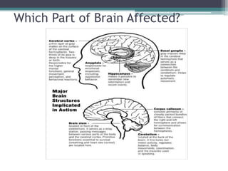 Which Part of Brain Affected?
 