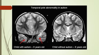 Autism and dev disorders