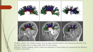 Autism and dev disorders
