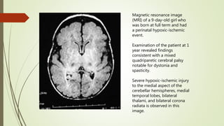 Autism and dev disorders