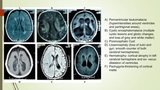 Autism and dev disorders
