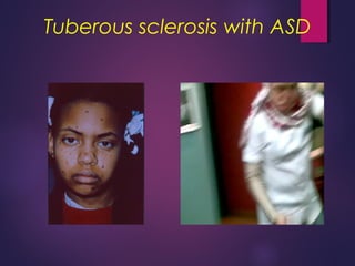Tuberous sclerosis with ASD
 