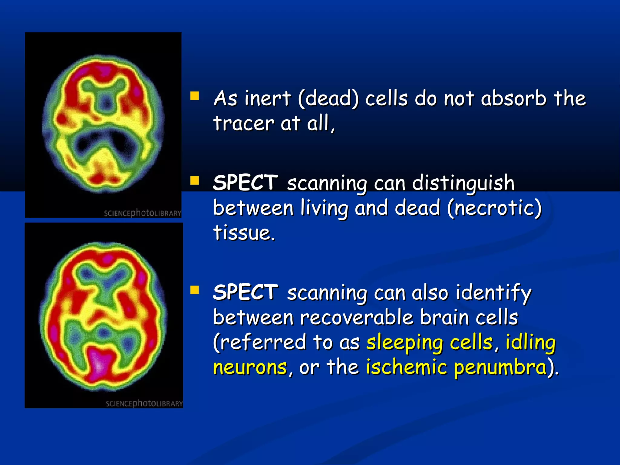  As inert (dead) cells do not absorb theAs inert (dead) cells do not absorb the
tracer at all,tracer at all,
 SPECTSPECT scanning can distinguishscanning can distinguish
between living and dead (necrotic)between living and dead (necrotic)
tissue.tissue.
 SPECTSPECT scanning can also identifyscanning can also identify
between recoverable brain cellsbetween recoverable brain cells
(referred to as(referred to as sleeping cellssleeping cells,, idlingidling
neuronsneurons, or the, or the ischemic penumbraischemic penumbra).).
 