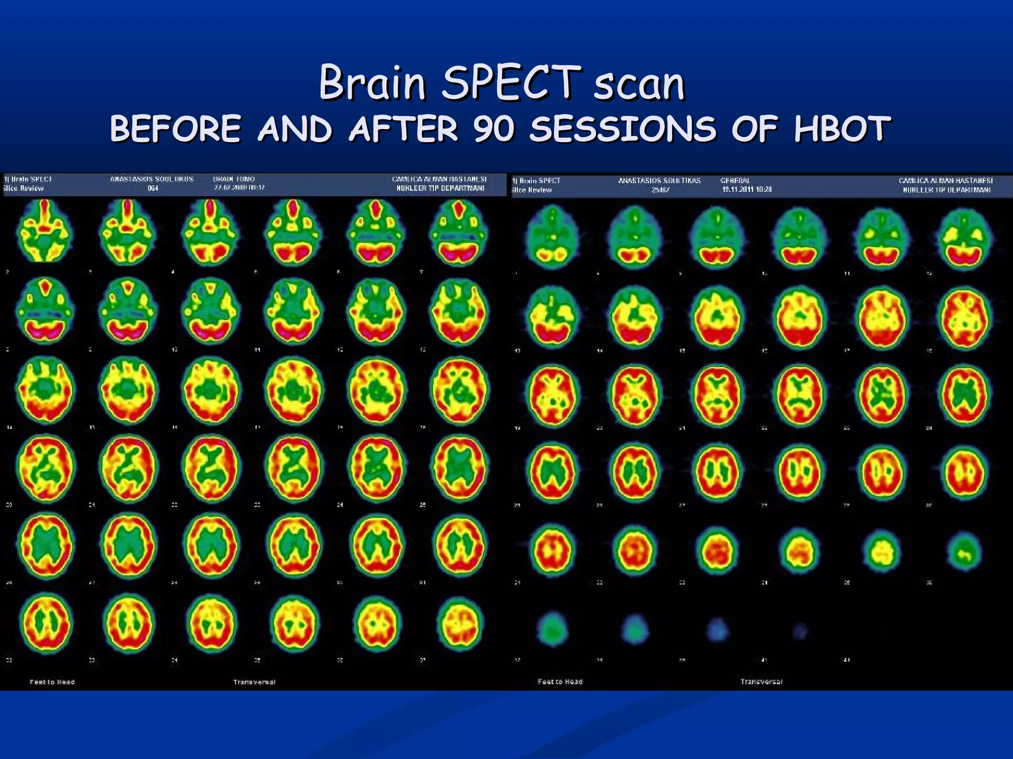 Brain SPECT scanBrain SPECT scan
BEFORE AND AFTER 90 SESSIONS OF HBOTBEFORE AND AFTER 90 SESSIONS OF HBOT
 