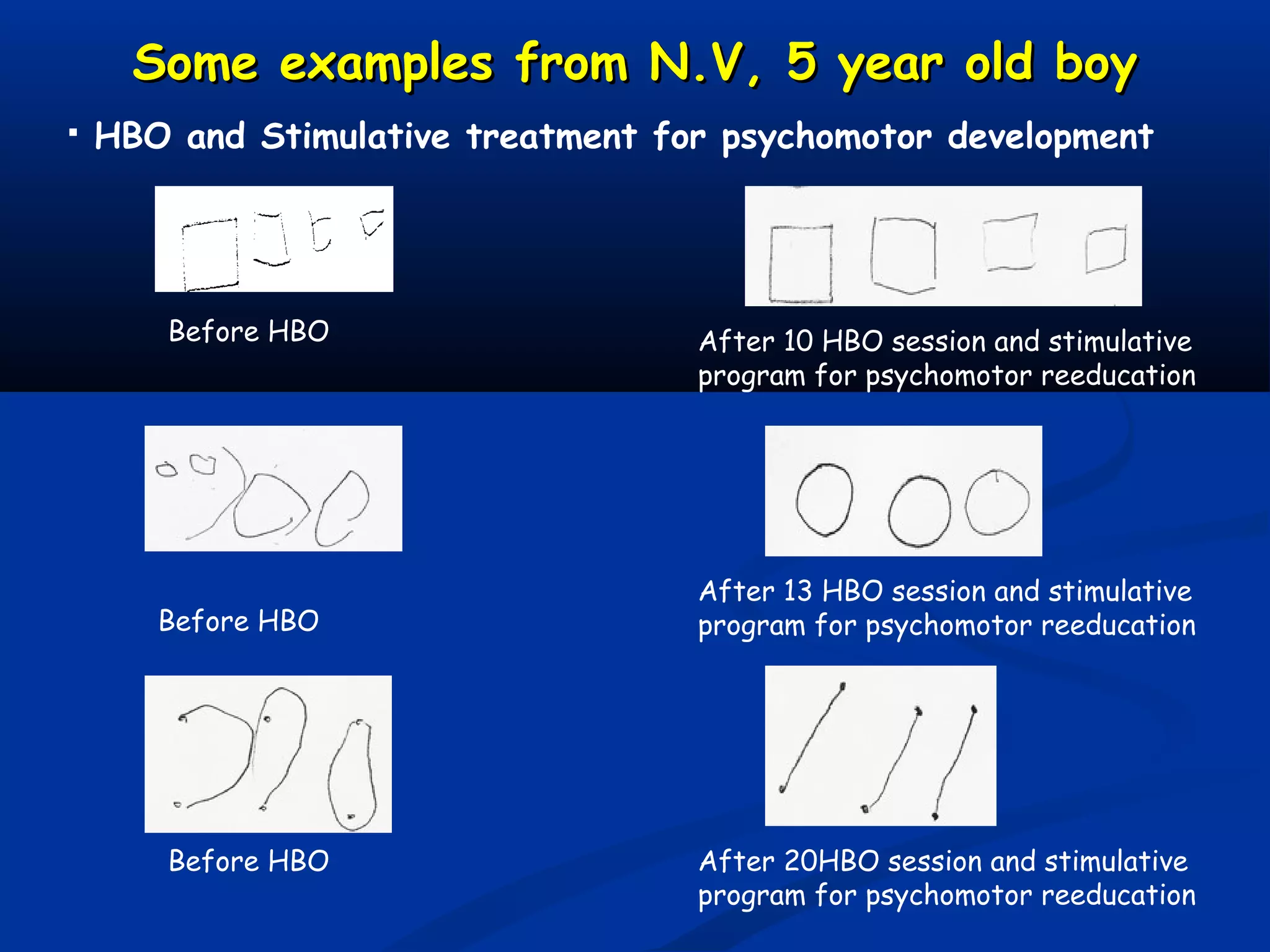 Some examples from N.V, 5 year old boySome examples from N.V, 5 year old boy
Before HBO
 HBO and Stimulative treatment for psychomotor development
After 10 HBO session and stimulative
program for psychomotor reeducation
Before HBO
After 20HBO session and stimulative
program for psychomotor reeducation
After 13 HBO session and stimulative
program for psychomotor reeducation
Before HBO
 