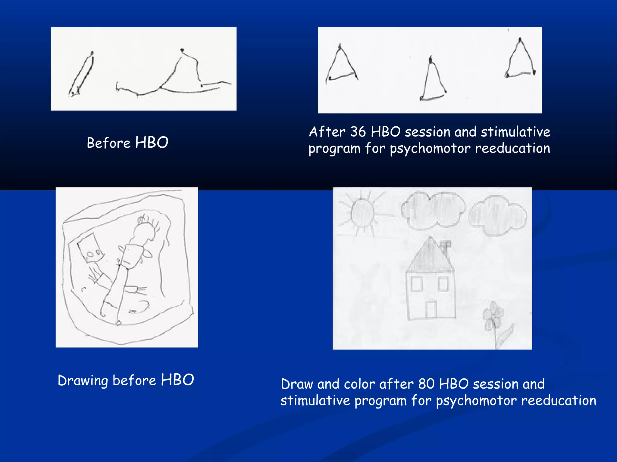 Before HBO
Drawing before HBO
After 36 HBO session and stimulative
program for psychomotor reeducation
Draw and color after 80 HBO session and
stimulative program for psychomotor reeducation
 
