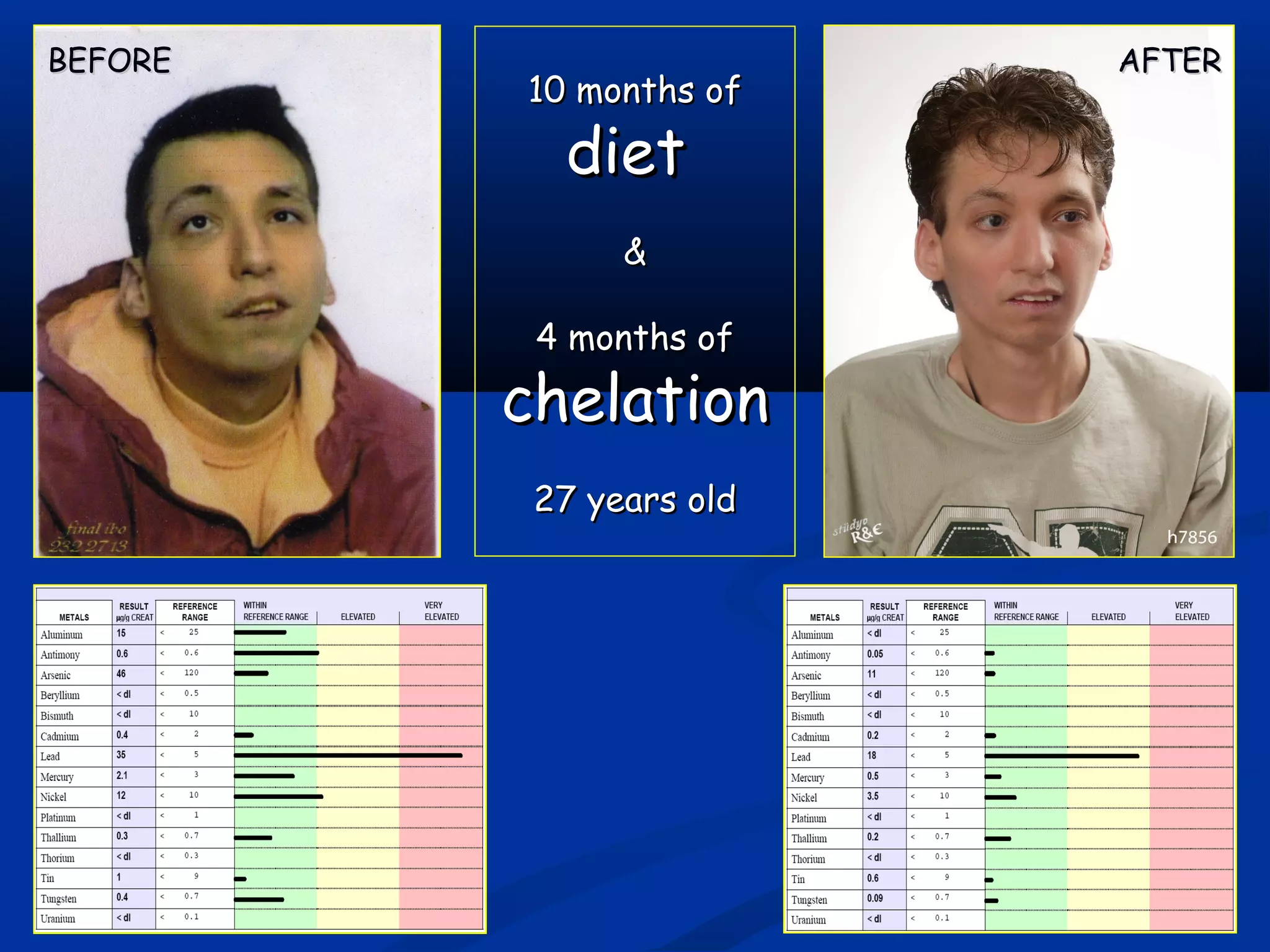 10 months of10 months of
dietdiet
&&
4 months of4 months of
chelationchelation
27 years old27 years old
BEFOREBEFORE AFTERAFTER
 