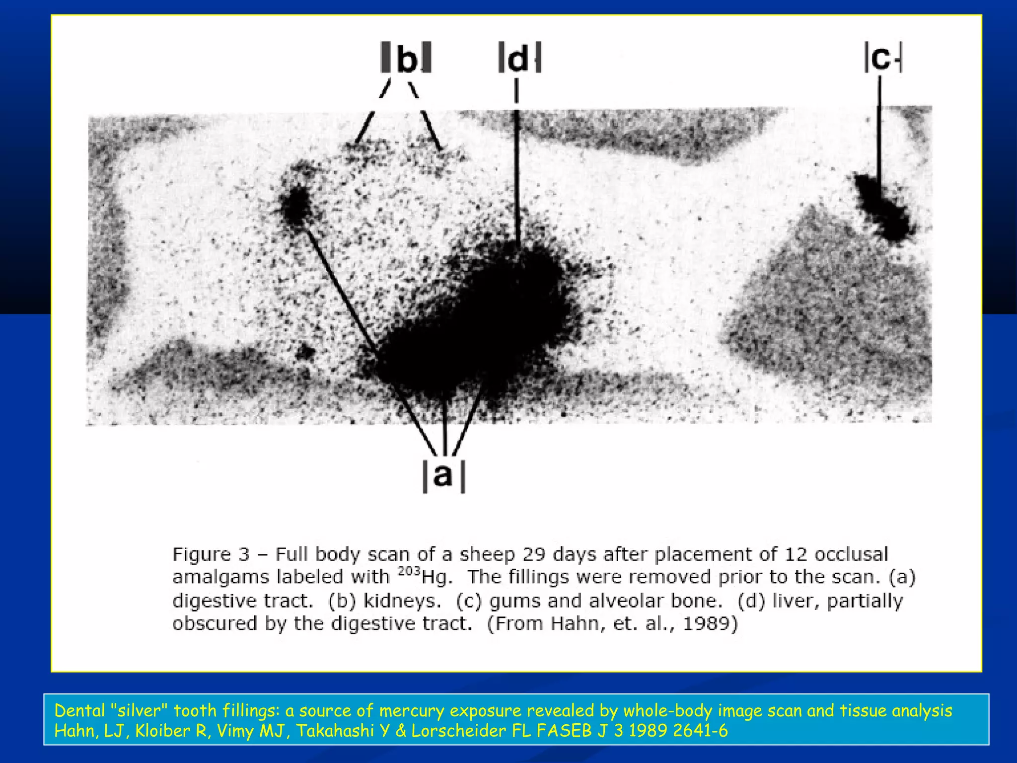 Dental "silver" tooth fillings: a source of mercury exposure revealed by whole-body image scan and tissue analysis
Hahn, LJ, Kloiber R, Vimy MJ, Takahashi Y & Lorscheider FL FASEB J 3 1989 2641-6
 
