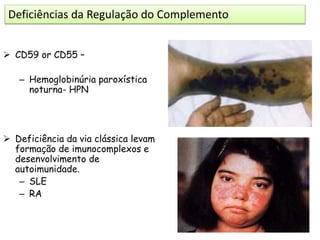  CD59 or CD55 –
– Hemoglobinúria paroxística
noturna- HPN
 Deficiência da via clássica levam
formação de imunocomplexos e
desenvolvimento de
autoimunidade.
– SLE
– RA
Deficiências da Regulação do Complemento
 