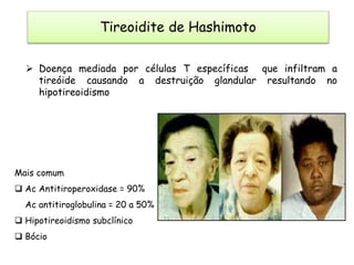  Doença mediada por células T específicas que infiltram a
tireóide causando a destruição glandular resultando no
hipotireoidismo
Mais comum
 Ac Antitiroperoxidase = 90%
Ac antitiroglobulina = 20 a 50%
 Hipotireoidismo subclínico
 Bócio
Tireoidite de Hashimoto
 